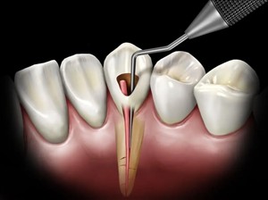 Endodonti